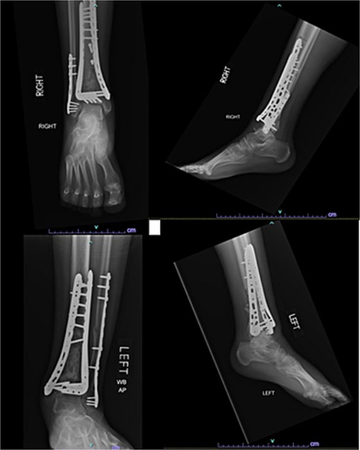 AP and lateral radiographs of patient 3 taken 3 months after posterior iliac crest bone grafting (7 months after index procedure).