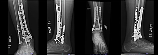 AP and lateral radiographs of patient 3 obtained 1 year and 9 months after the index procedure, demonstrating right ankle arthrodesis and a healed left ankle.