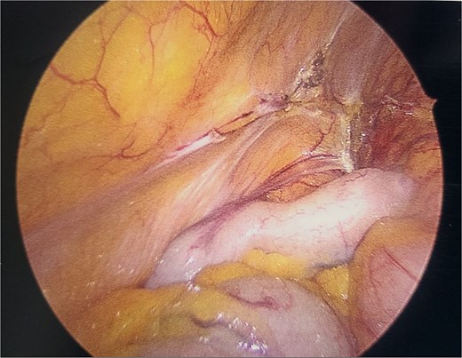 Intraoperative image of appendix during initial index procedure.