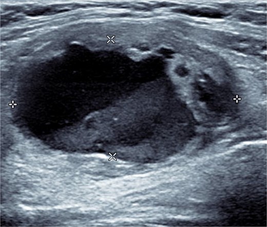 USS of the thyroid demonstrating the cystic lesion in the left thyroid gland.