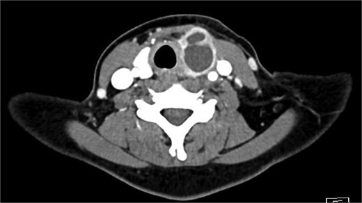 Axial portal venous phase CT of the neck demonstrating the cystic lesion in the left thyroid gland.