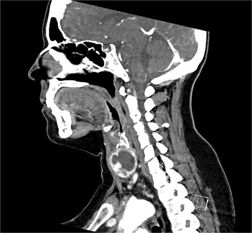 Sagittal portal venous phase CT of the neck demonstrating the cystic lesion in the left thyroid gland.