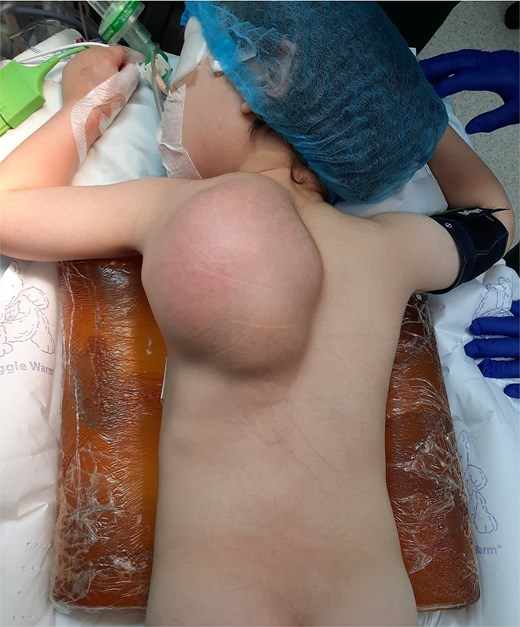 Preoperative appearance of tumour.