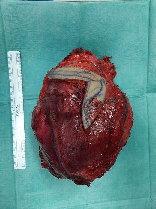 Resected scapular desmoid tumour.