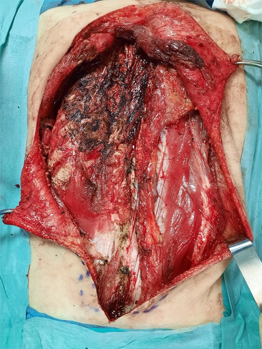 Post-resection defect in the scapular region showing loss of stabilizing muscles.