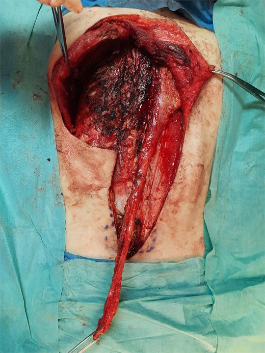 Trapezius muscle flap elongated with a strip of lumbosacral fascia.