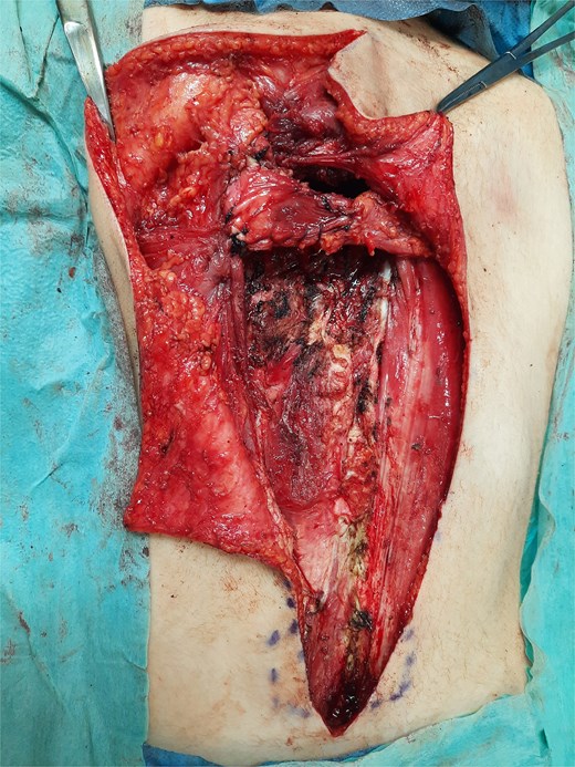 Inset of the flap after passage through bone tunnel and fixation.