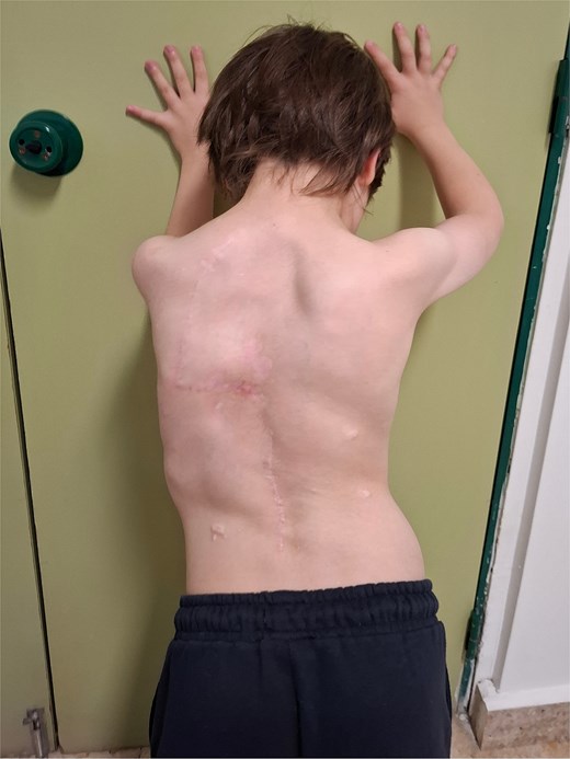 Four-year postoperative result showing preserved scapular stability without winging.