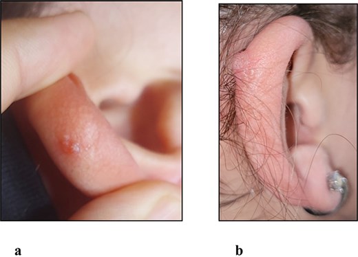 (a) Clinical photograph of the initial lesion to right ear prior to curettage. (b) Clinical photograph of the recurrent lesion to right ear 5 months after curettage.