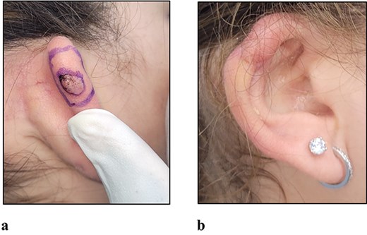 (a) Clinical photograph of the recurrent lesion prior to surgical excision using 5 mm margins. (b) Clinical photograph of the reconstructed ear at 3 months post-operative.