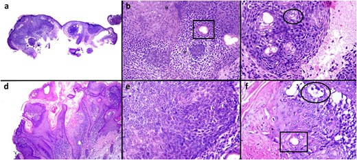 Original lesion (a–c) from the right ear demonstrating a lobular basaloid tumour arising from the epidermis (a). Higher magnification highlights a proliferation of small somewhat basaloid cells with prominent spongiosis (b, SP) giving a poroid appearance (b). There are squamous eddies similar to that seen in irritated seborrheic keratosis (b, SE). Both sebaceous ductular (b, box) and sebocyte (c, circle) differentiation are present. The recurrent lesion (d–f) demonstrates increased papillomatous epidermal hyperplasia and squamatization (d). Nevertheless, the basaloid nature of the proliferation is identified (e) and focally, both ductular (e, box) and rare sebocyte (e, circle) differentiation are appreciated. Haematoxylin and eosin a, d ×40; b, c, e, f ×200.