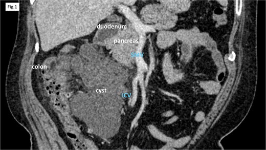 CT showed cystic lesions localized within the right colic mesentery.