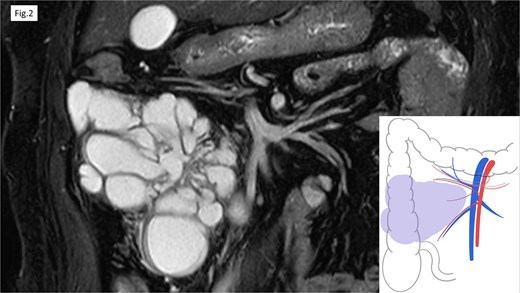 MRI revealed the multifocal cystic lesions, which lacked distinct enhancement.