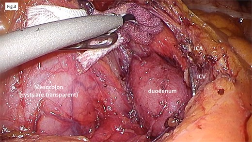 Operative findings. The procedure began with a mesenteric incision at the caudal level of the ICA/V. Dissection along the fusion fascia confirmed the preservation of the duodenum. We addressed the mesentery containing the cyst by ligating the ICA/V, making an incision along the right margin of the SMV, and resected the accessory right colic vein.