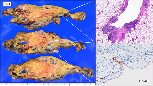 Histopathological findings. Cysts of varying sizes were observed within the mesentery. The cyst lumens exhibited smooth contours with no evidence of enhancing lesions. The cyst linings consisted of a sparse single layer of flat to cuboidal cells. D2–40 showed partial positivity but with inconsistent results. These findings suggested the possibility of lymphangiomatosis.