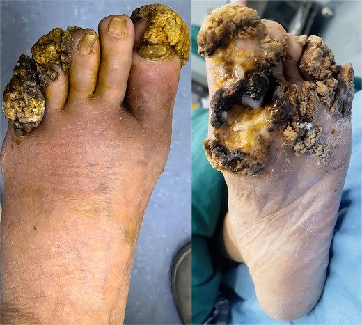 Extensive verrucae vulgares on the plantar and dorsal aspects of the left foot in a 54-year-old immunocompromised woman.
