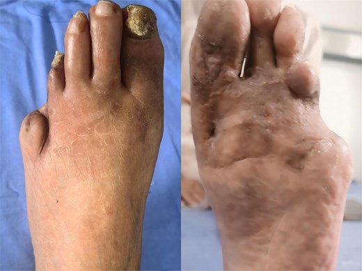 Left foot of the same patient 6 months after two-stage excision, split-thickness grafting and 44°C hyperthermia, showing complete remission, and minimal scarring.