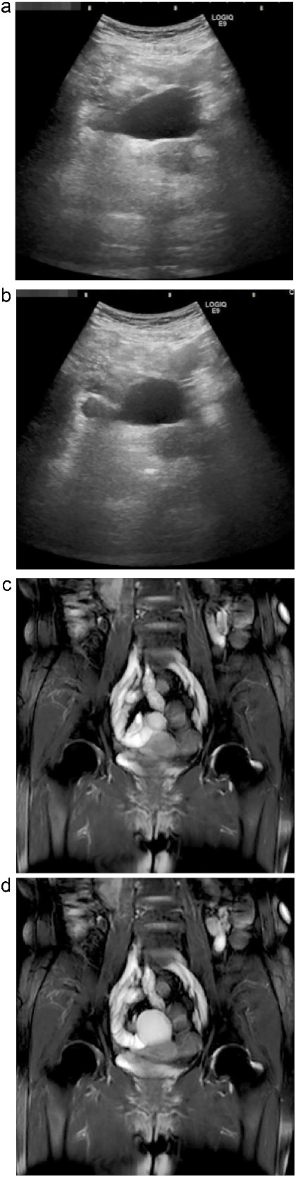Dynamic ultrasonography and MRI of the abdominal cystic lesion. (a, b) Abdominal ultrasonography revealed a 6-cm cystic lesion with a layered wall structure. Image (b) was taken 4 s after (a), showing deformation of the cyst wall, indicating peristaltic motion. (c, d) Coronal T2-weighted MRI demonstrated a high-intensity cystic lesion adjacent to the ileum. Image (d) was obtained 1.5 s after (c), also showing peristaltic movement of the cyst wall. These dynamic imaging features suggested a duplication cyst with smooth muscle activity.