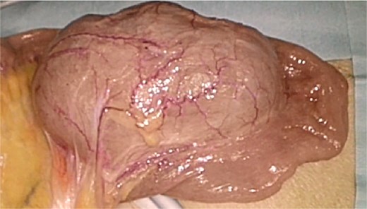 Intraoperative findings during single-incision laparoscopic surgery. The duplication cyst was located on the mesenteric side of the ileum, ~40 cm from the ileocecal valve. The lesion showed visible peristalsis and shared a muscular wall with the adjacent ileum.