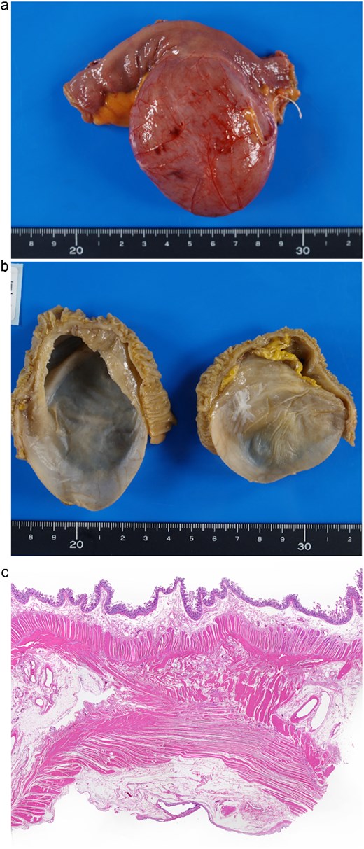 Macroscopic and histopathological findings of the resected specimen. (a) Gross specimen of the cystic lesion attached to the ileum. (b) Internal surface of the cystic lumen, appearing smooth and uniform. (c) Histological section stained with haematoxylin and eosin. The cyst wall consisted of columnar epithelium and a two-layered smooth muscle wall. There was no mucosal communication with the adjacent ileum, but partial sharing of the muscle layer was observed (H&E stain, magnification ×100).
