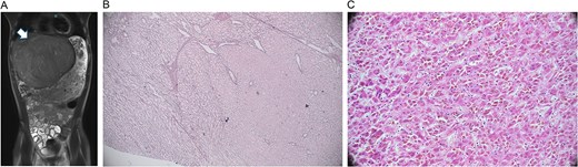 Radiology and pathology findings from a 14-year-old male with hepatocellular carcinoma (HCC). (A) MRI abdomen/pelvis with large, encapsulated liver mass (arrow) and associated mass effect. (B) Reticulin stain revealed the adenoma component with an intact staining pattern at the periphery and the HCC component with loss of staining at the center. (C) High power haematoxylin and eosin stain of hepatocellular carcinoma.