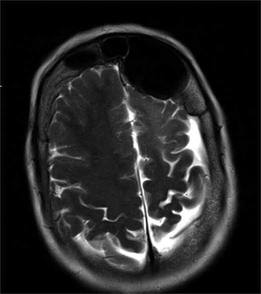 MRI showing enlarged left frontal sinus with mass effect on the frontal lobe.