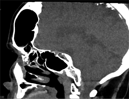 CT scan axial view showing hyperaeration of the left frontal sinus.