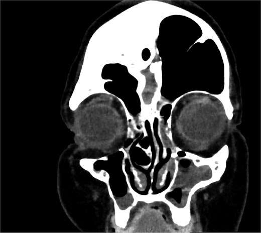 Coronal CT showing volume loss in the left hemisphere and enlarged sinus.