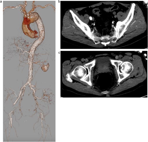 Preoperative contrast-enhanced computed tomography (CT) showing severe narrowing of the true lumen at the abdominal aorta, with dynamic obstruction of both renal arteries and static obstruction of the left external iliac and right common femoral arteries. (a) Three-dimensional reconstruction, (b) axial CT image at the level of iliac arteries, and (c) axial CT image at the level of femoral arteries.