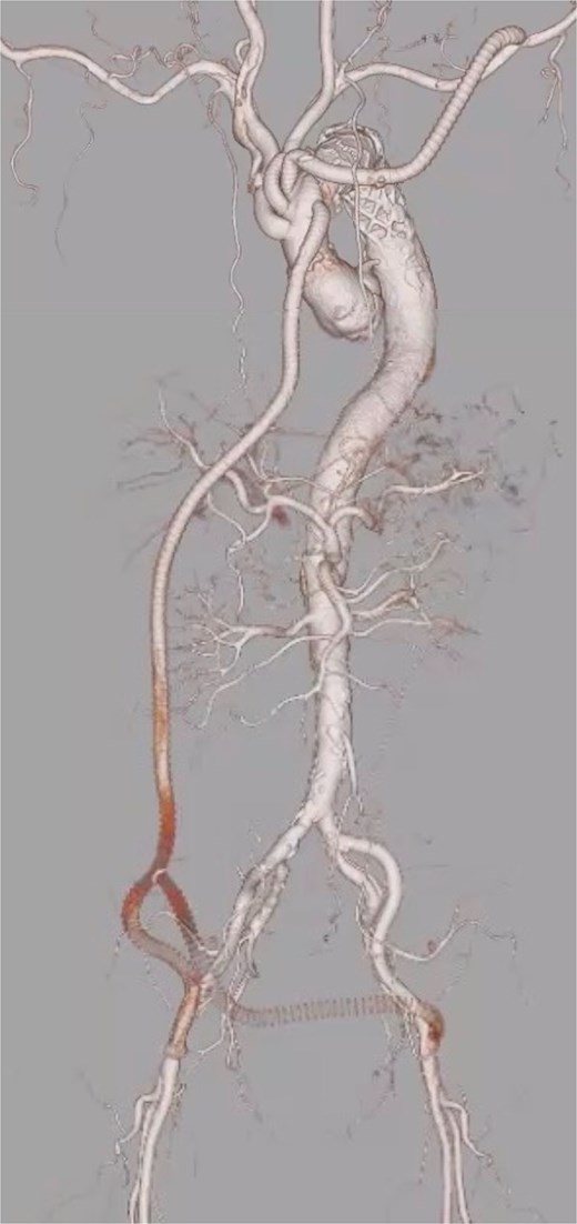 Postoperative contrast-enhanced 3D computed tomography demonstrating successful total arch replacement with frozen elephant trunk insertion and ascending aorta-to-bilateral femoral artery (Ao-F) bypass. Although the Ao-F bypass graft is occluded, lower limb perfusion is preserved via expansion of the true lumen following central repair.