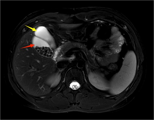 Upper abdominal MRI demonstrates a double gallbladder variation. The two arrows indicate the respective gallbladders, the lateral one of which contains multiple gallstones.