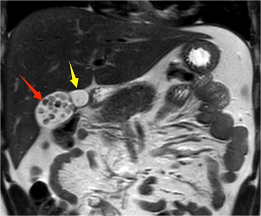 Upper abdominal MRI coronal view demonstrates a double gallbladder variation. The two arrows indicate the respective gallbladders, the lateral one of which contains multiple gallstones.