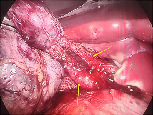 Intraoperative image showing two cystic ducts, each indicated by an arrow.