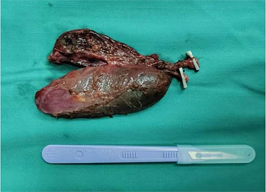 Postoperative specimen showing two completely independent gallbladders, each with its own separate cystic duct.