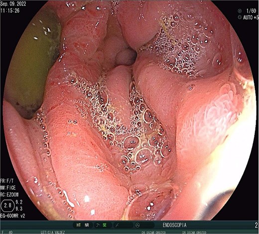 Gastrocutaneous fistula.