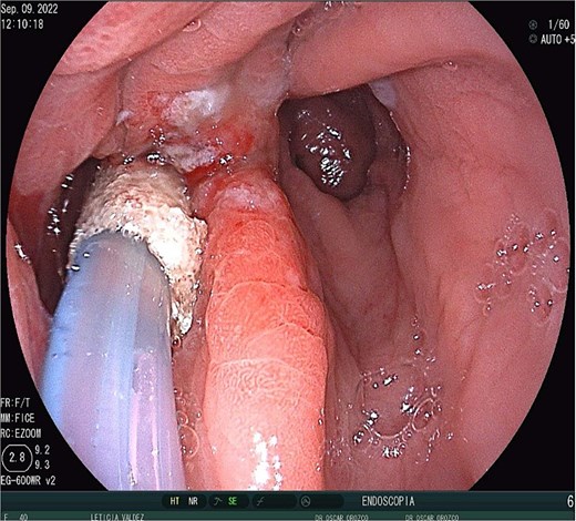 EndoVAC therapy.