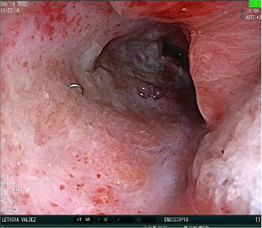 Post-EndoVAC therapy. Closure of the fistula is seen.