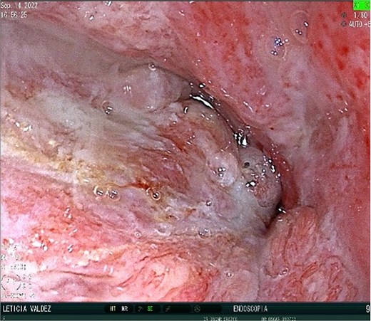 Close-up post-EndoVAC therapy. Closure of the fistula is seen.