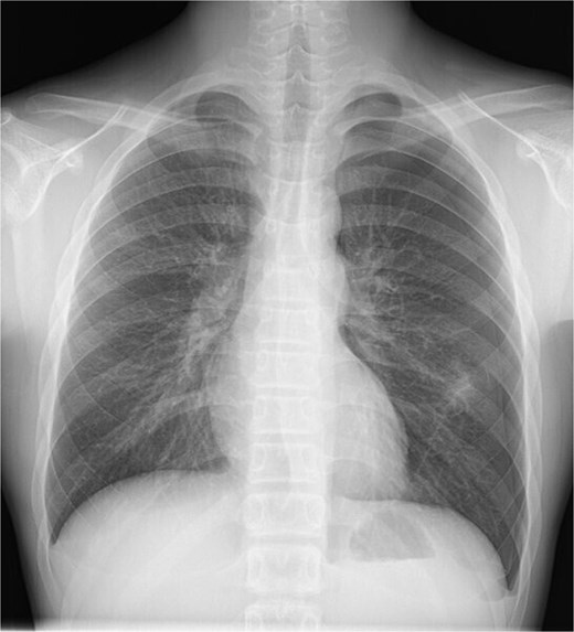 Chest radiography showing a left pneumothorax and an opacity in the left middle lung field.
