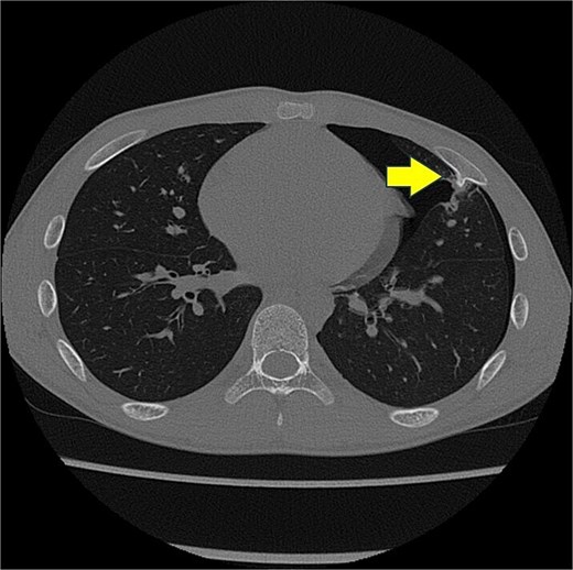 Chest computed tomography scan showing a left pneumothorax and a mass arising from the fifth rib to the thoracic cavity (arrow). The cortical bone and bone marrow continue to move from the fifth rib.