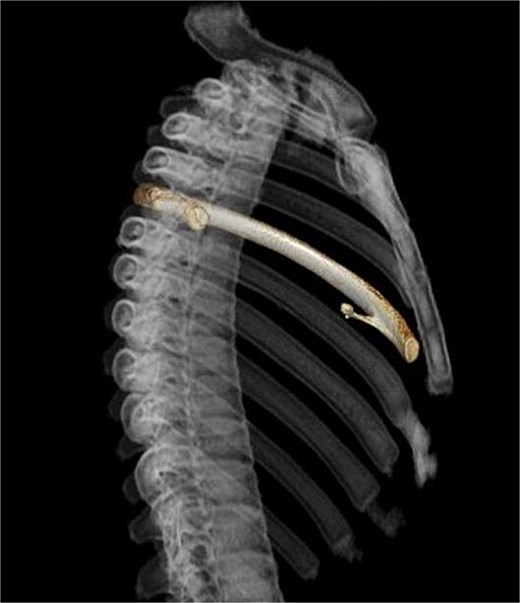 Three-dimensional computed tomography. Slim and pedunculated osteochondroma arising from the anterior fifth rib into the thoracic cavity.