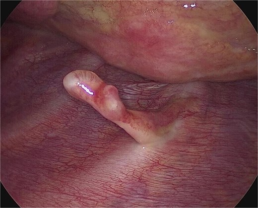 Intraoperative finding of the osteochondroma. Slim and pedunculated osteochondroma arising from the anterior aspect of the fifth rib.