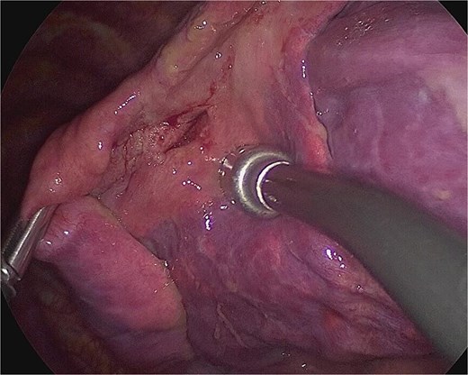 Intraoperative finding of the wound in the left lingular segment. There was a wound in the left lingular segment and a thickened visceral pleura around the wound.