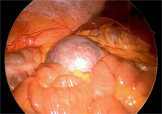 Wandering accessory spleen located in right upper quadrant with patient in Trendelenburg position.