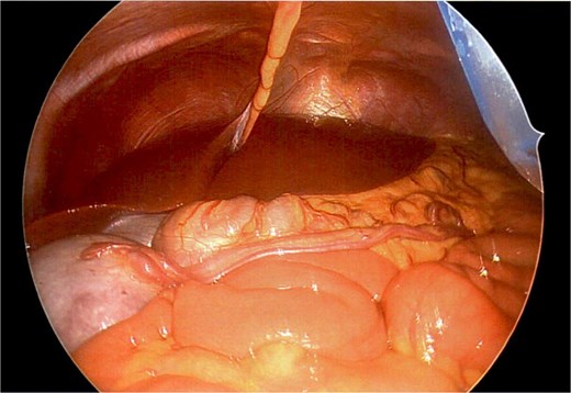 Long vascular pedicle of accessory spleen leading to left upper quadrant.