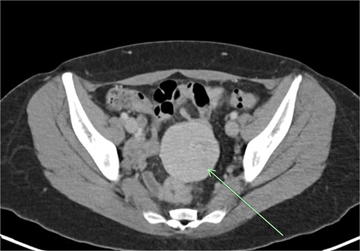 CT demonstrating initial pelvic location of accessory spleen.