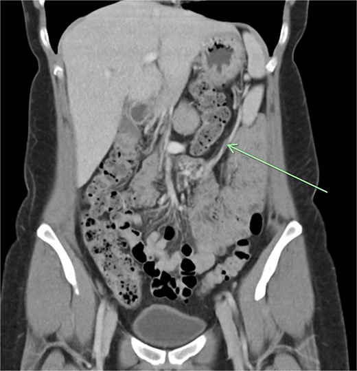 Long vascular pedicle leading to accessory spleen in the pelvis.