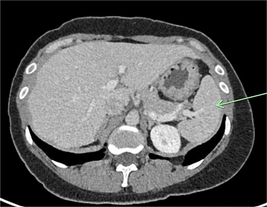 Normal spleen identified in left upper quadrant.