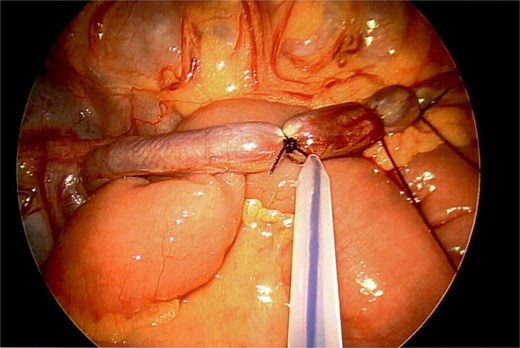 Ligation of vascular pedicle.