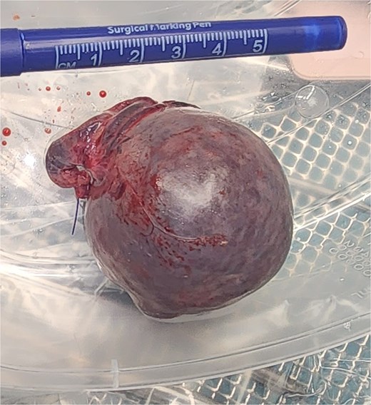 Extracted accessory spleen.